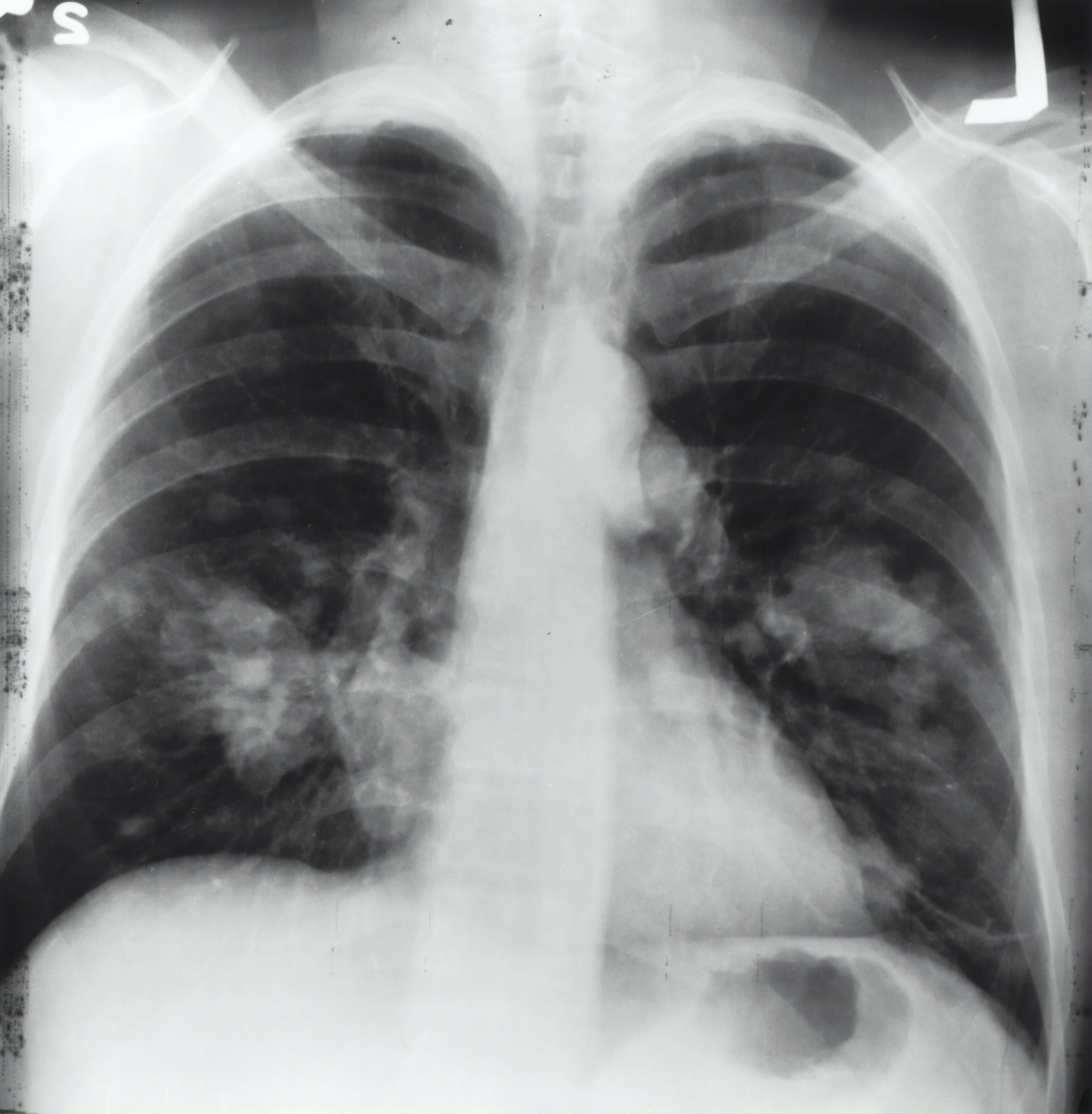Chest X-ray